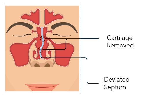 Septoplasty 3.png