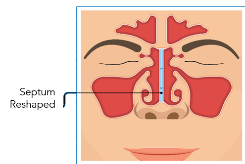 Septoplasty 4.png