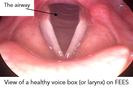 Swallowing - Fibreoptic Endoscopic Evaluation of Swallowing (FEES) 1.png