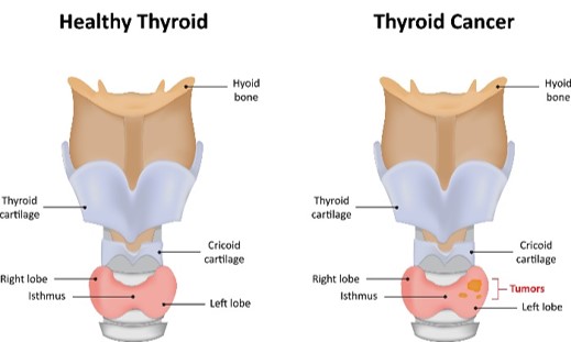 Thyroid Cancer1.jpg