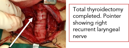 Thyroidectomy 1.png