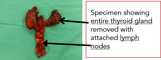 Thyroidectomy 2.png