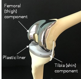 Total Knee Replacement Prostheses.jpg