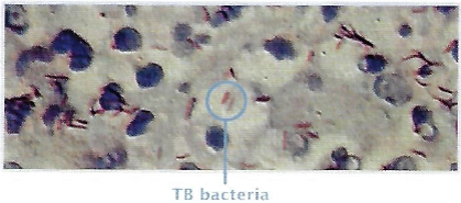 Tuberculosis 1.png