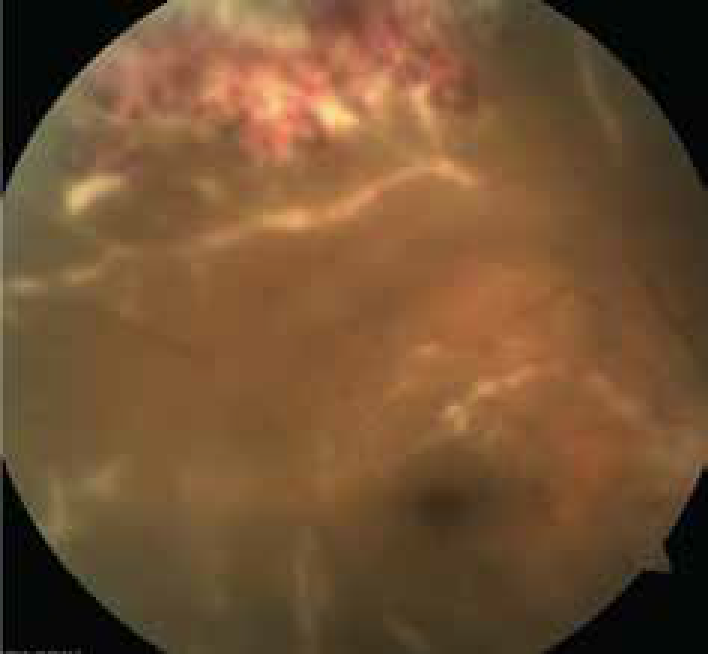 Uveitis (Posterior) 2.png
