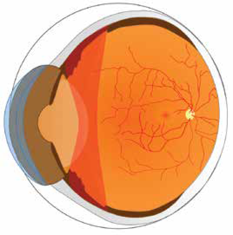 Uveitis (Posterior).png
