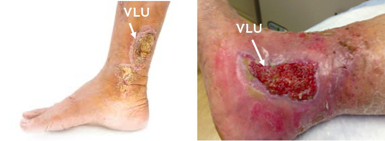 Venous Leg Ulcer 2.png