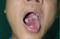oral tongue cancer.png
