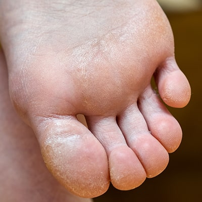 Care-of-Calluses-and-Corns-12-min.jpg