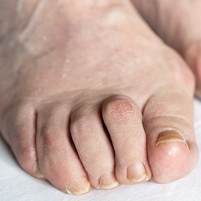 Care-of-Toe-Deformities-12-min.jpg