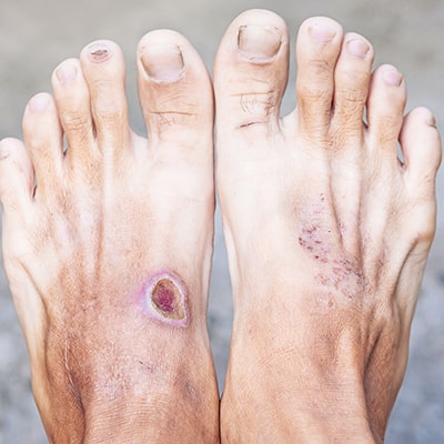 How-Diabetes-Affects-the-Foot-min.jpg