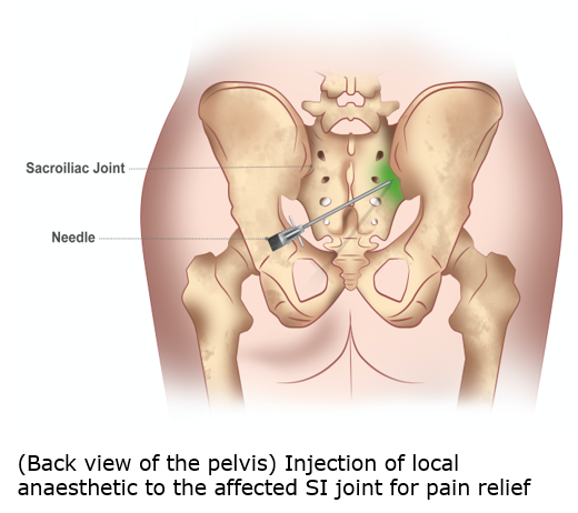 Sacroiliac Joint Pain and Piriformis Syndrome 2.png