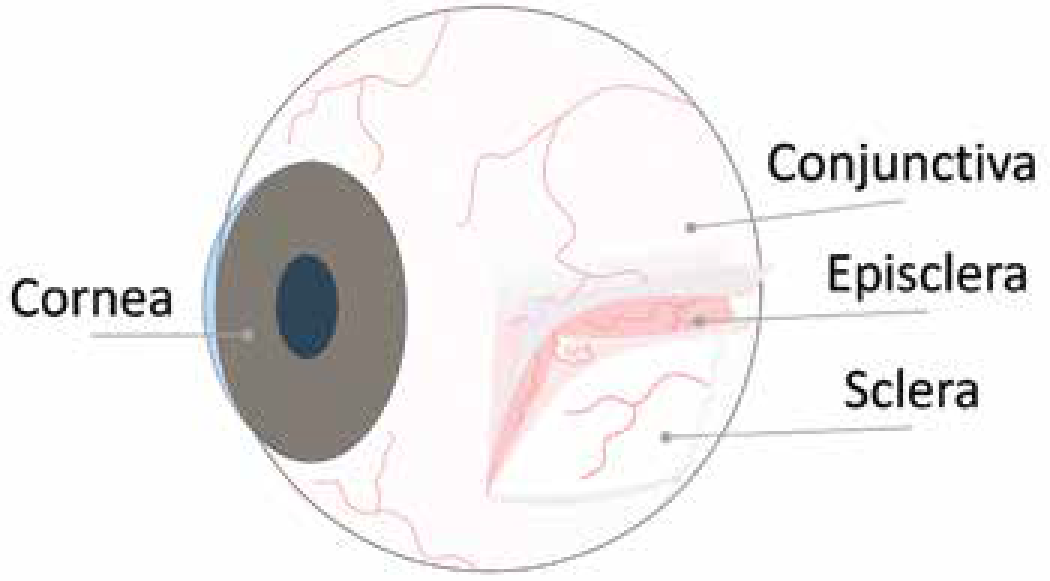 Episcleritis and Scleritis 1-01.png