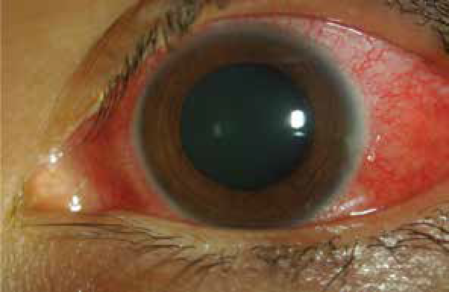 Episcleritis and Scleritis 2-01.png