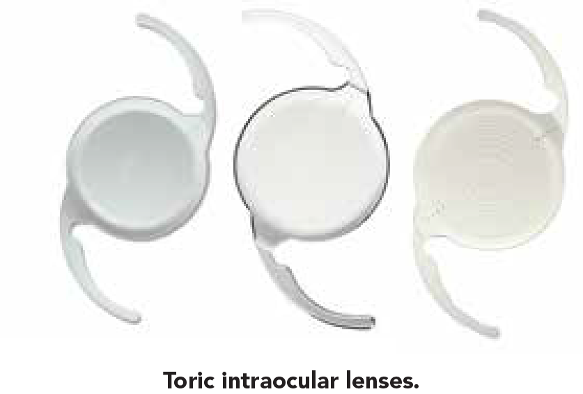 Intraocular Lenses And Refractive Options 3-01.png