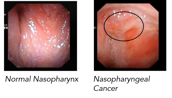 Nasopharyngeal Cancer 2.png