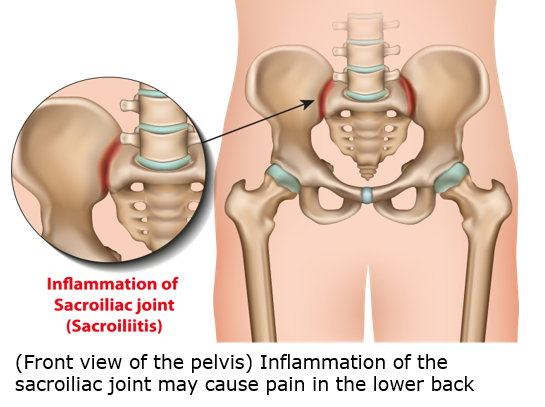 Sacroiliac Joint Pain and Piriformis Syndrome 1.png
