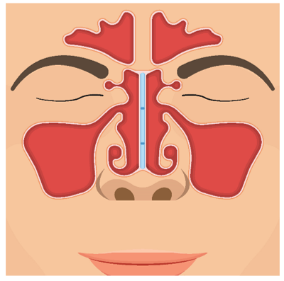 Septoplasty 1.png