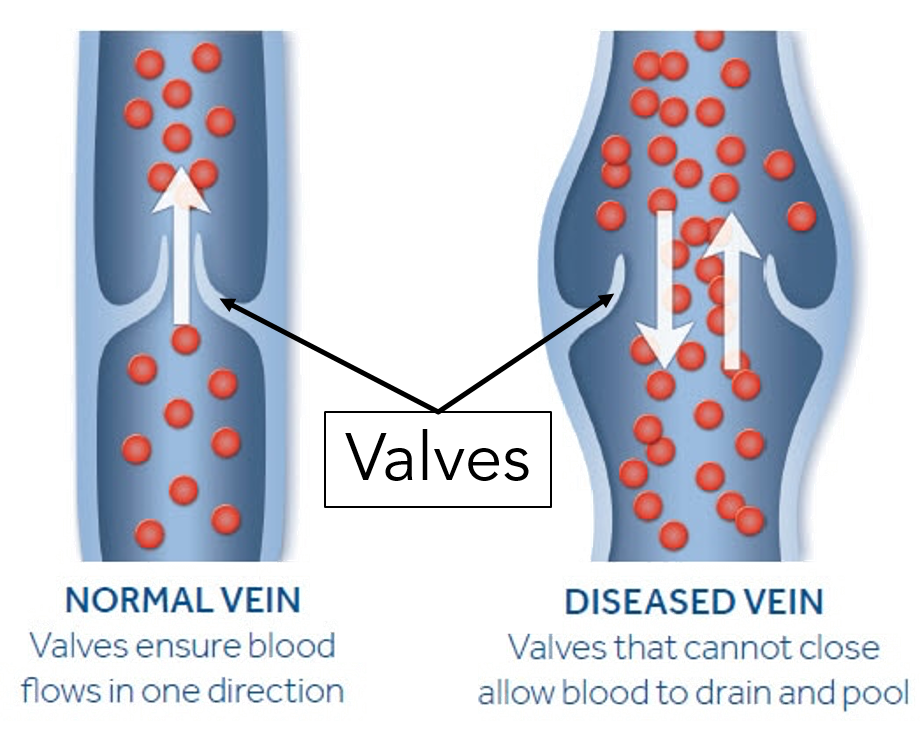 Venous Leg Ulcer 1.png