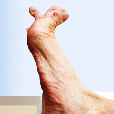 Care-of-Foot-Deformity-12-min.jpg