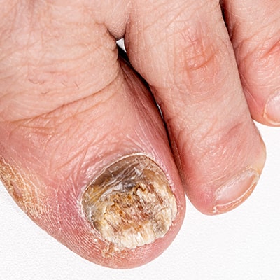 Care-of-Fungal-Nails-12-min.jpg